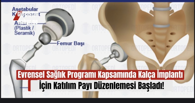 Evrensel Sağlık Programı Kapsamında Kalça İmplantı İçin Katılım Payı Düzenlemesi Başladı!